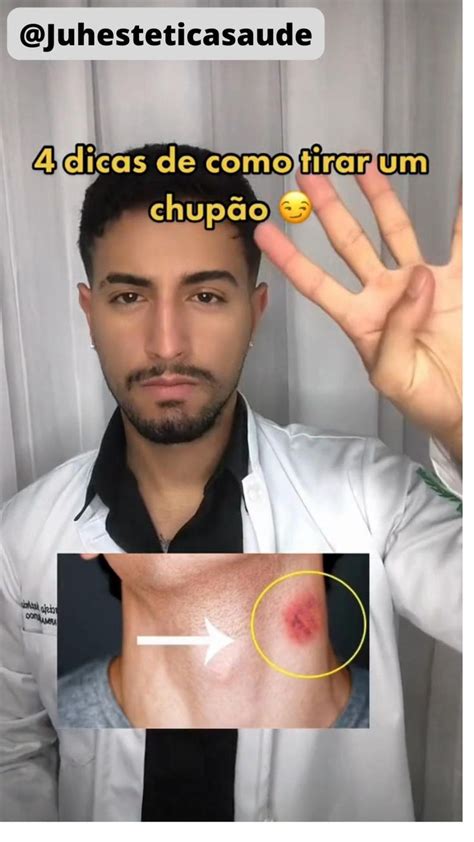 chupão no peito|Como tirar um Chupão: 5 dicas que ajudam rapidamente